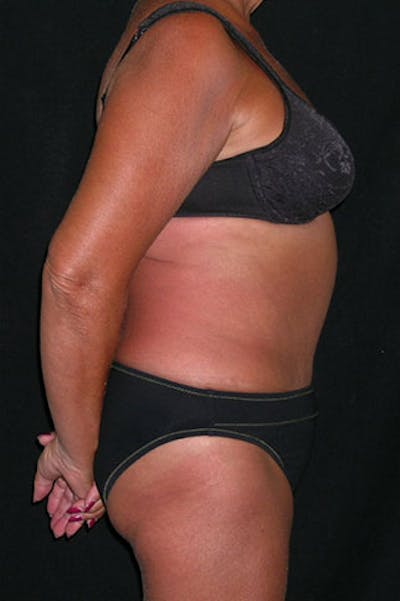 Tummy Tuck Before & After Gallery - Patient 23533814 - Image 10