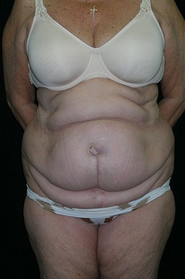 Tummy Tuck Before & After Gallery - Patient 23533816 - Image 1