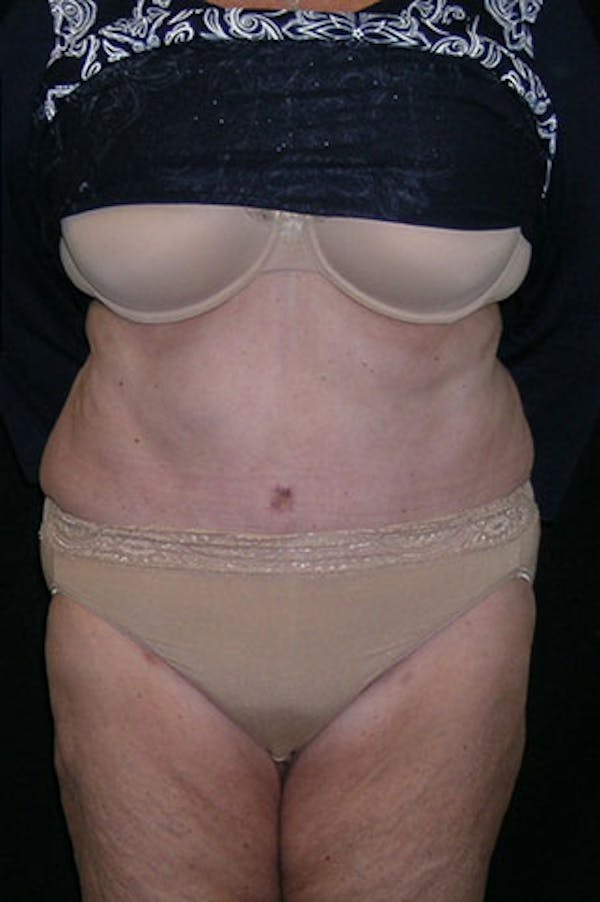 Tummy Tuck Before & After Gallery - Patient 23533816 - Image 2