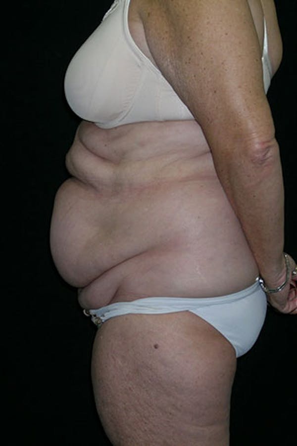 Tummy Tuck Before & After Gallery - Patient 23533816 - Image 3