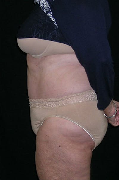 Tummy Tuck Before & After Gallery - Patient 23533816 - Image 4