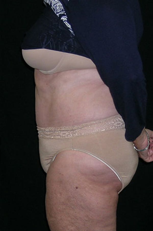 Tummy Tuck Before & After Gallery - Patient 23533816 - Image 4