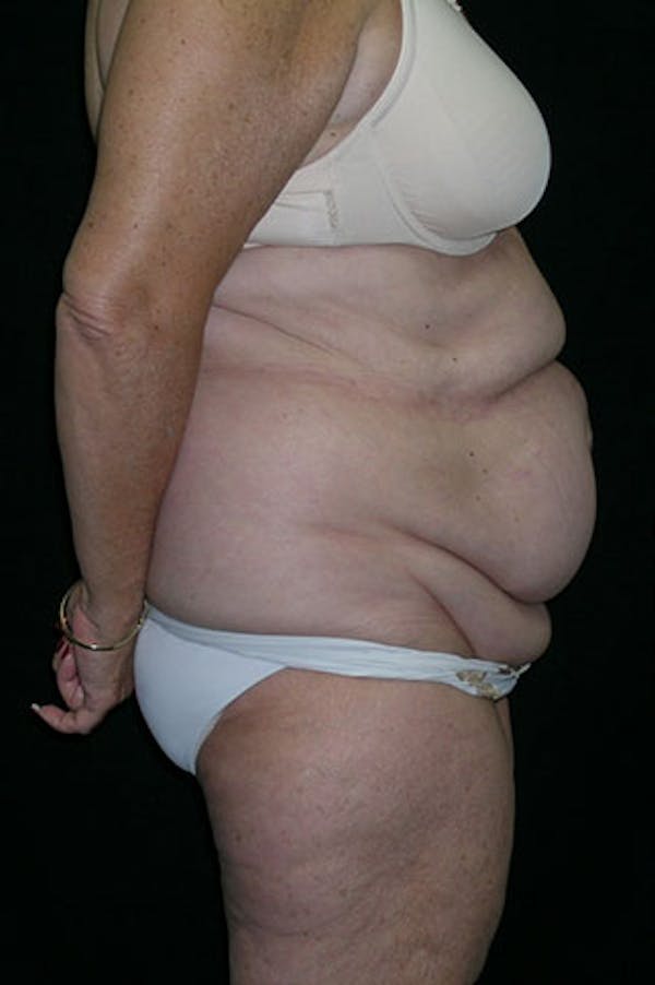 Tummy Tuck Before & After Gallery - Patient 23533816 - Image 5