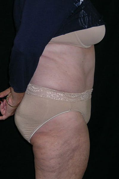 Tummy Tuck Before & After Gallery - Patient 23533816 - Image 6