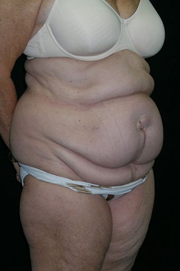Tummy Tuck Before & After Gallery - Patient 23533816 - Image 7