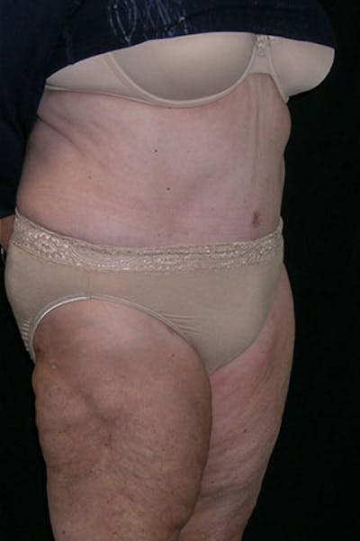 Tummy Tuck Before & After Gallery - Patient 23533816 - Image 8