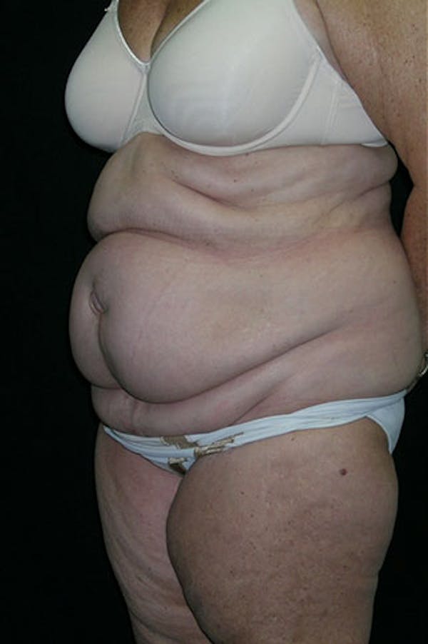 Tummy Tuck Gallery - Patient 23533816 - Image 9