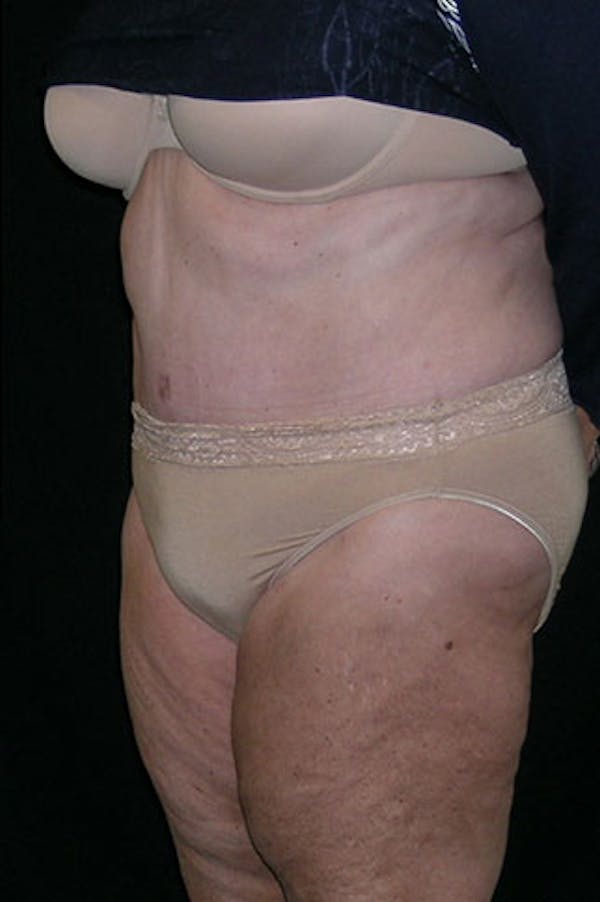 Tummy Tuck Before & After Gallery - Patient 23533816 - Image 10