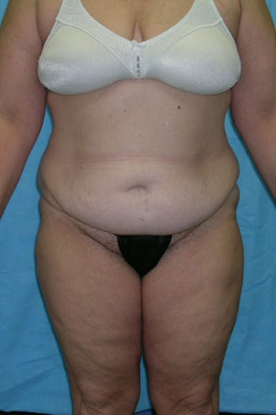 Tummy Tuck Before & After Gallery - Patient 23533844 - Image 1