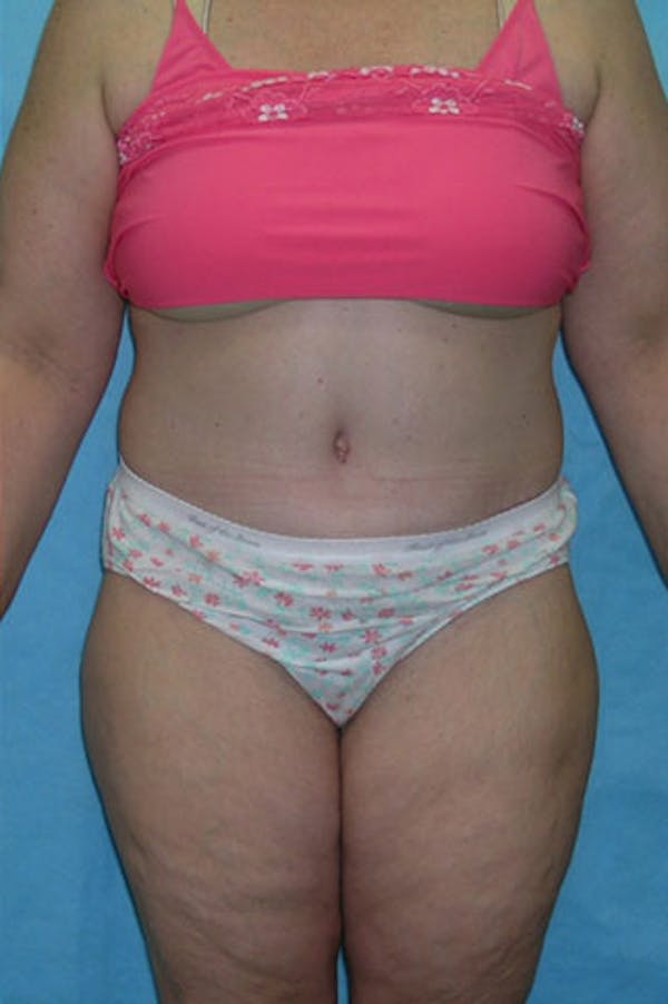 Tummy Tuck Before & After Gallery - Patient 23533844 - Image 2