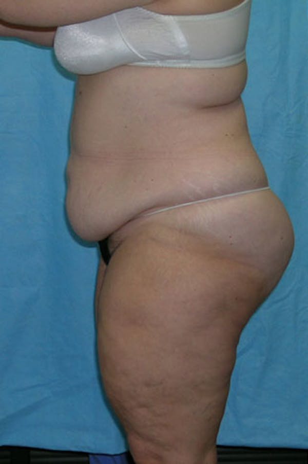 Tummy Tuck Gallery - Patient 23533844 - Image 3