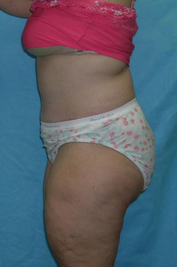 Tummy Tuck Before & After Gallery - Patient 23533844 - Image 4