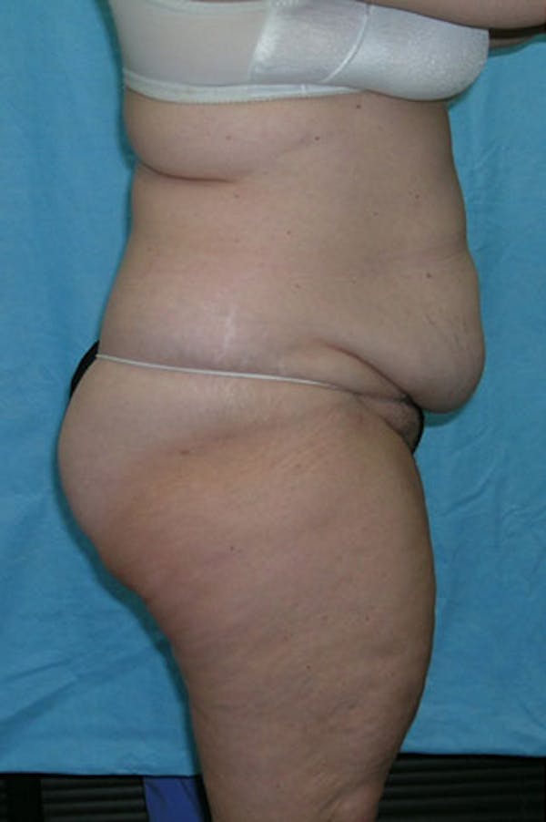 Tummy Tuck Gallery - Patient 23533844 - Image 5