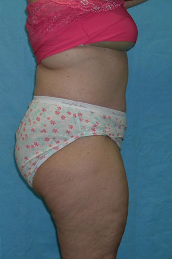 Tummy Tuck Before & After Gallery - Patient 23533844 - Image 6