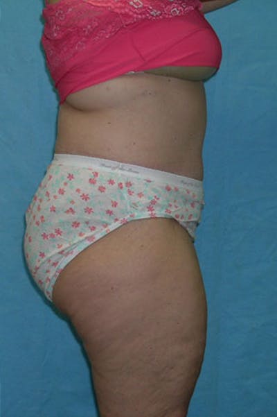 Tummy Tuck Before & After Gallery - Patient 23533844 - Image 6