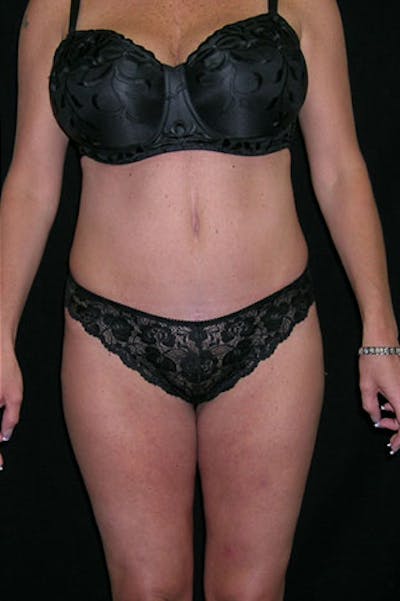 Tummy Tuck Before & After Gallery - Patient 23533845 - Image 2