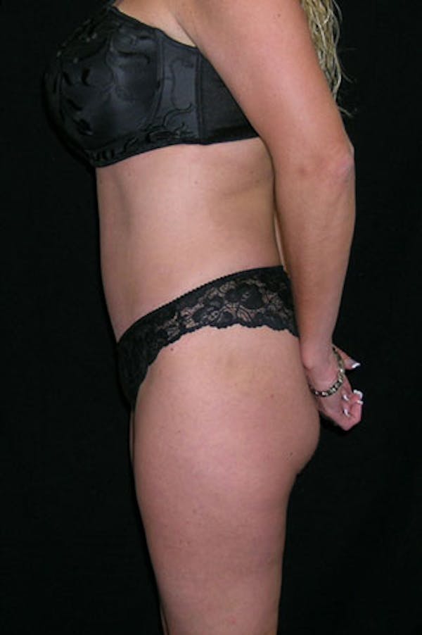 Tummy Tuck Before & After Gallery - Patient 23533845 - Image 4