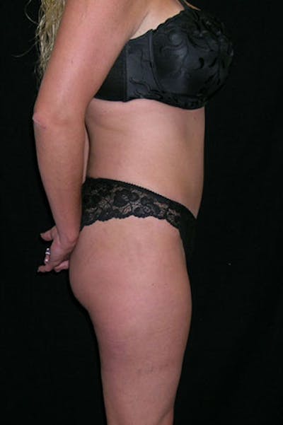 Tummy Tuck Before & After Gallery - Patient 23533845 - Image 6