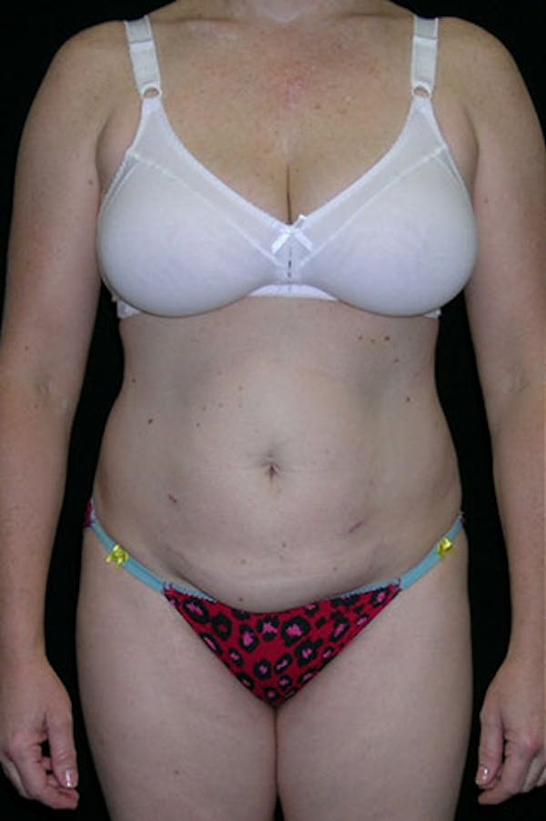 Tummy Tuck Before & After Gallery - Patient 23533847 - Image 1