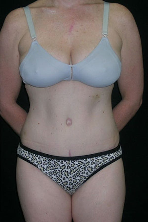 Tummy Tuck Before & After Gallery - Patient 23533847 - Image 2