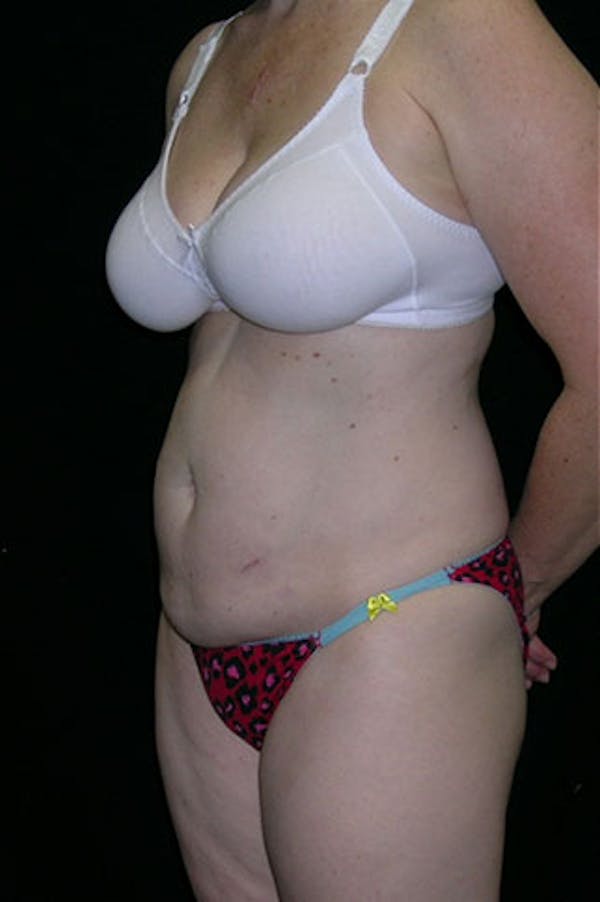 Tummy Tuck Before & After Gallery - Patient 23533847 - Image 3