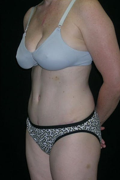 Tummy Tuck Gallery - Patient 23533847 - Image 4
