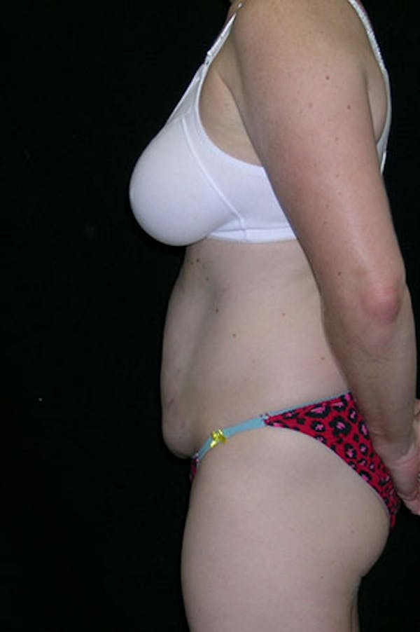 Tummy Tuck Before & After Gallery - Patient 23533847 - Image 5