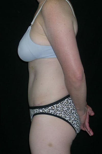 Tummy Tuck Before & After Gallery - Patient 23533847 - Image 6