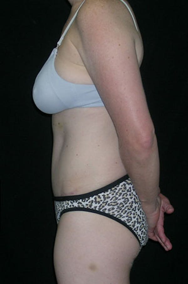 Tummy Tuck Before & After Gallery - Patient 23533847 - Image 6