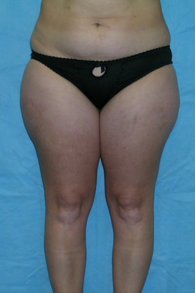 Liposuction & SmartLipo Before & After Gallery - Patient 23533848 - Image 1