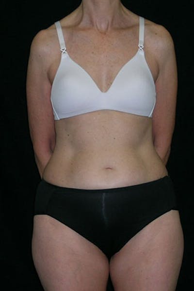 Tummy Tuck Before & After Gallery - Patient 23533850 - Image 1