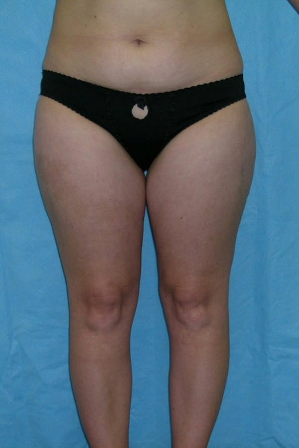 Liposuction & SmartLipo Before & After Gallery - Patient 23533848 - Image 2
