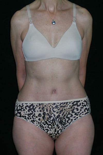 Tummy Tuck Before & After Gallery - Patient 23533850 - Image 2