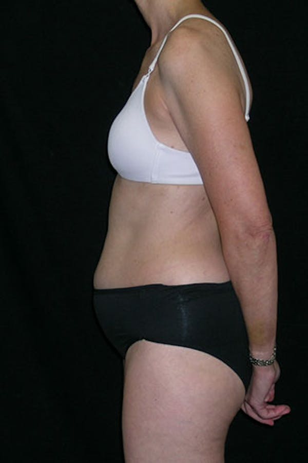 Tummy Tuck Before & After Gallery - Patient 23533850 - Image 3