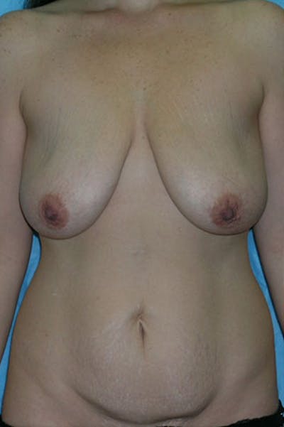 Mommy Makeover Before & After Gallery - Patient 23533851 - Image 1