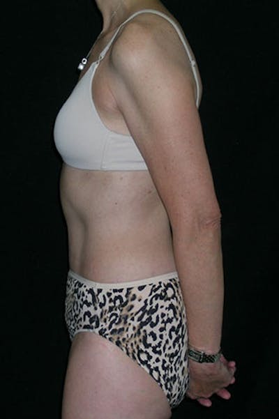 Tummy Tuck Before & After Gallery - Patient 23533850 - Image 4