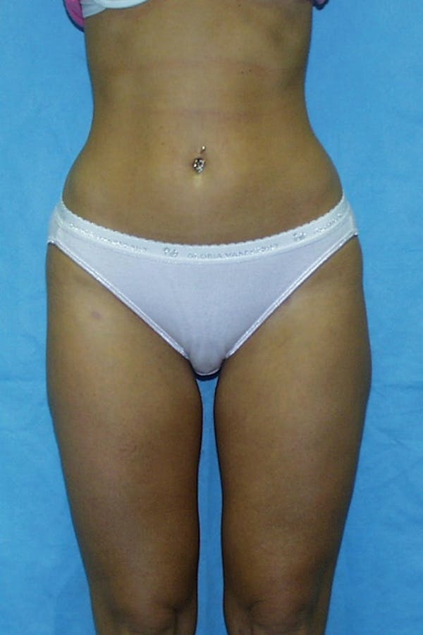 Liposuction & SmartLipo Before & After Gallery - Patient 23533849 - Image 2