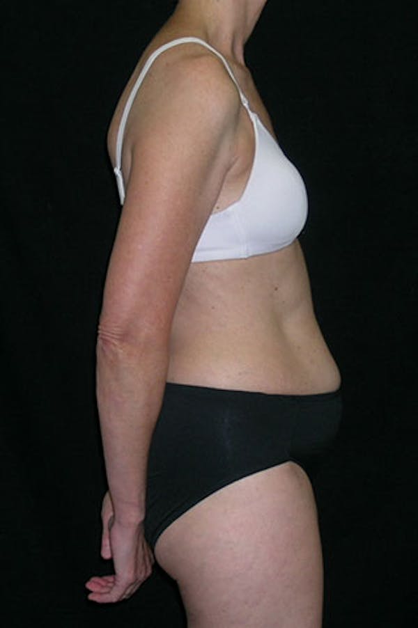 Tummy Tuck Before & After Gallery - Patient 23533850 - Image 5