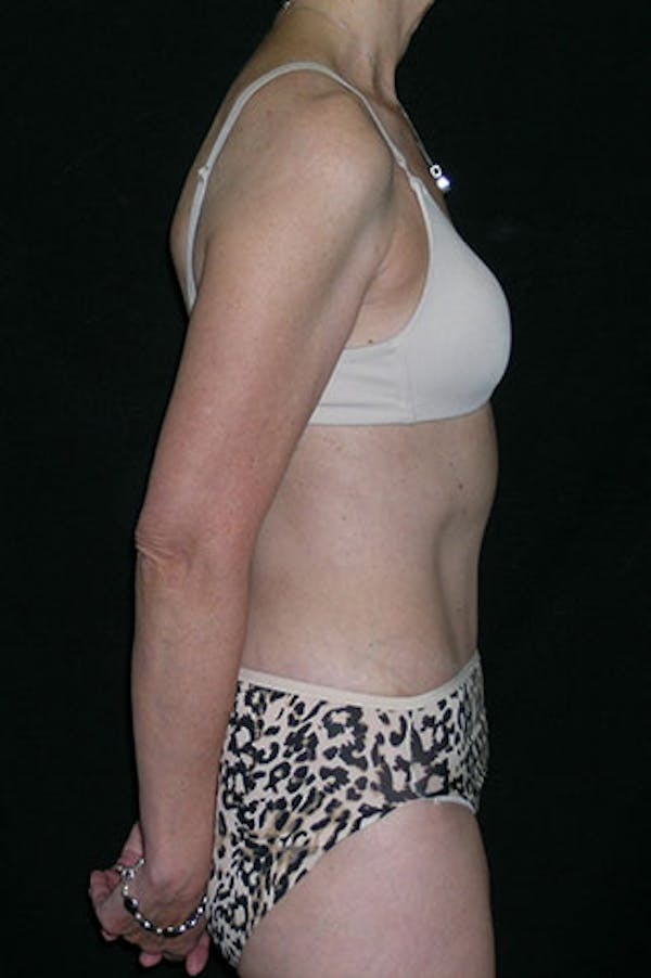 Tummy Tuck Before & After Gallery - Patient 23533850 - Image 6
