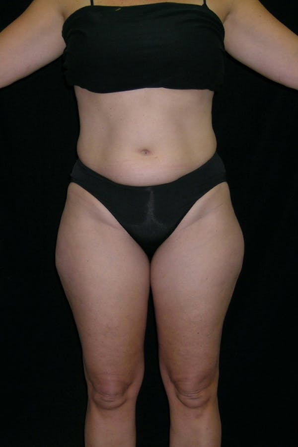 Liposuction & SmartLipo Before & After Gallery - Patient 23533854 - Image 1