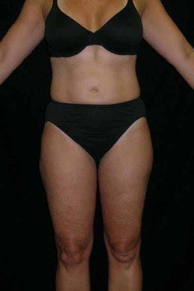Liposuction & SmartLipo Before & After Gallery - Patient 23533854 - Image 2