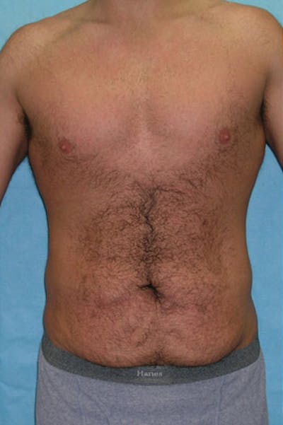 Tummy Tuck Before & After Gallery - Patient 23533857 - Image 1