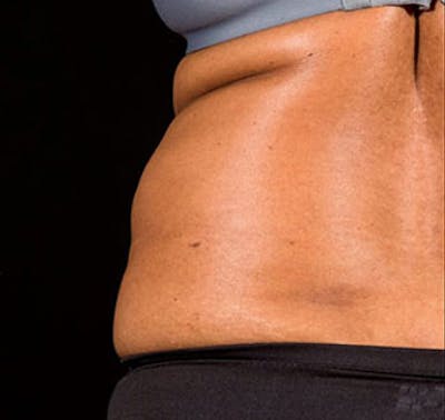 SculpSure Before & After Gallery - Patient 23533855 - Image 1