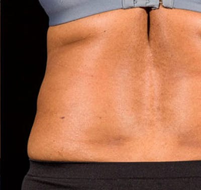 SculpSure Before & After Gallery - Patient 23533855 - Image 2