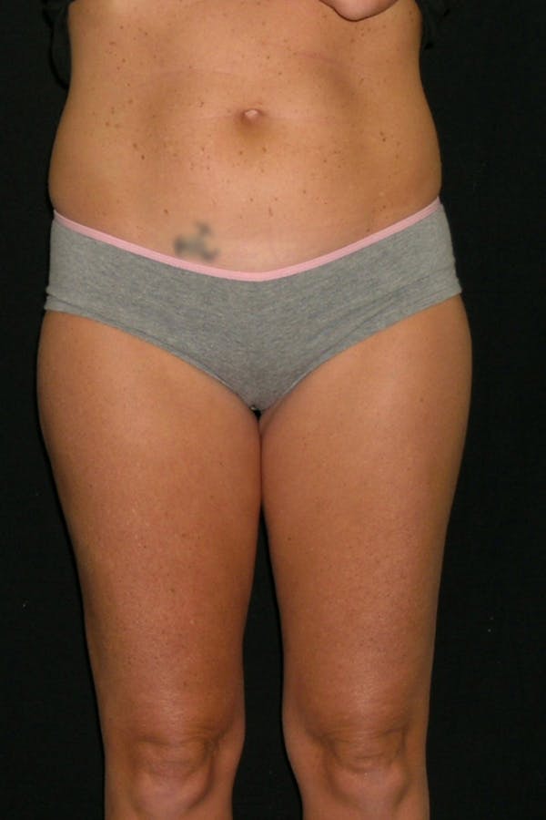 Liposuction & SmartLipo Before & After Gallery - Patient 23533856 - Image 2