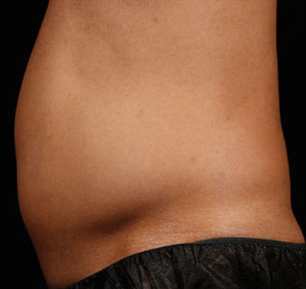 SculpSure Before & After Gallery - Patient 23533858 - Image 1