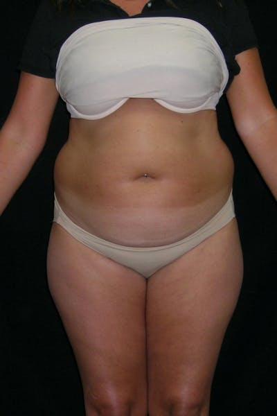 Liposuction & SmartLipo Before & After Gallery - Patient 23533860 - Image 1