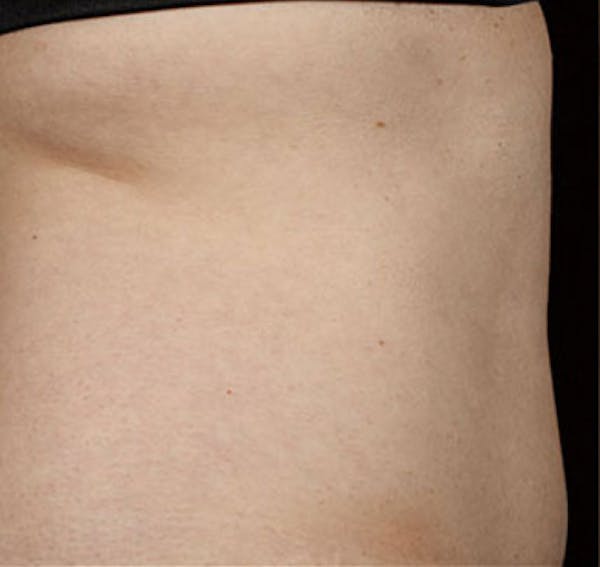 SculpSure Before & After Gallery - Patient 23533859 - Image 1