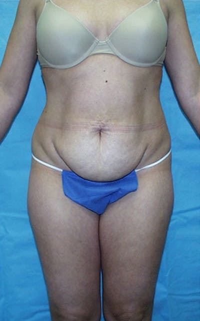 Tummy Tuck Before & After Gallery - Patient 23533866 - Image 1
