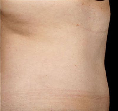 SculpSure Before & After Gallery - Patient 23533859 - Image 2